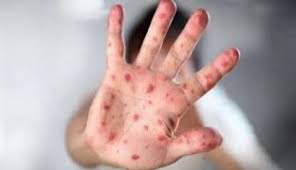 Kadiskes: Virus Mpox Belum Terdeteksi di Riau