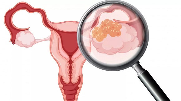 Waspada Kanker Serviks! Perempuan Diimbau Manfaatkan IVA Test Gratis di Puskesmas